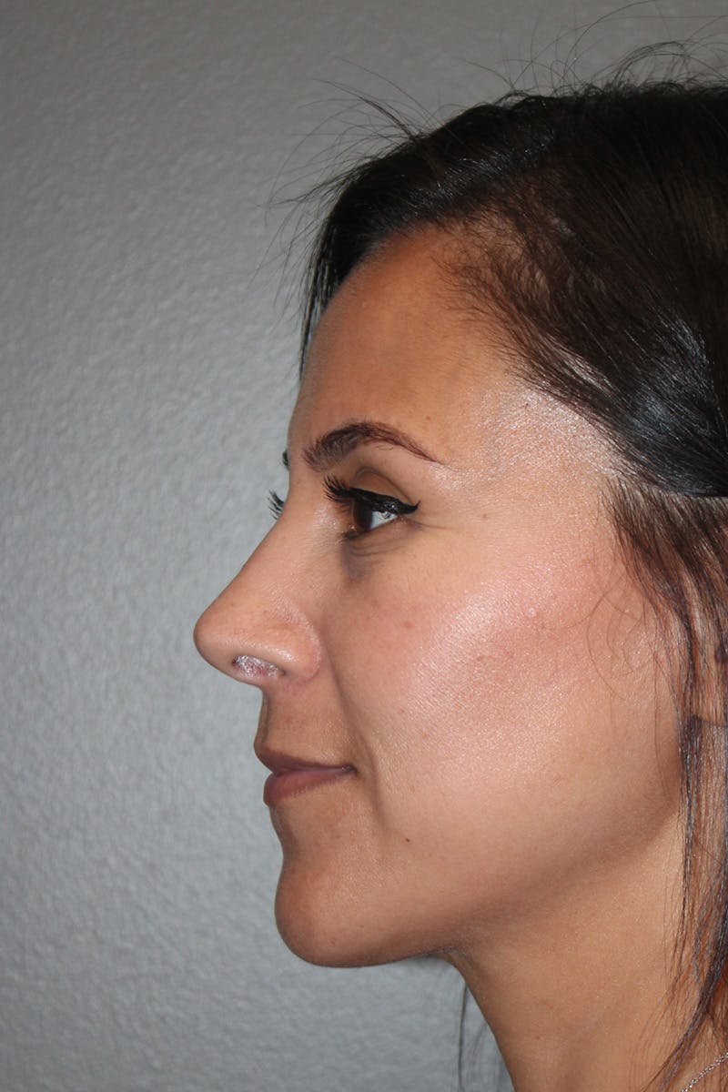 Rhinoplasty Before & After Gallery - Patient 174972181 - Image 10