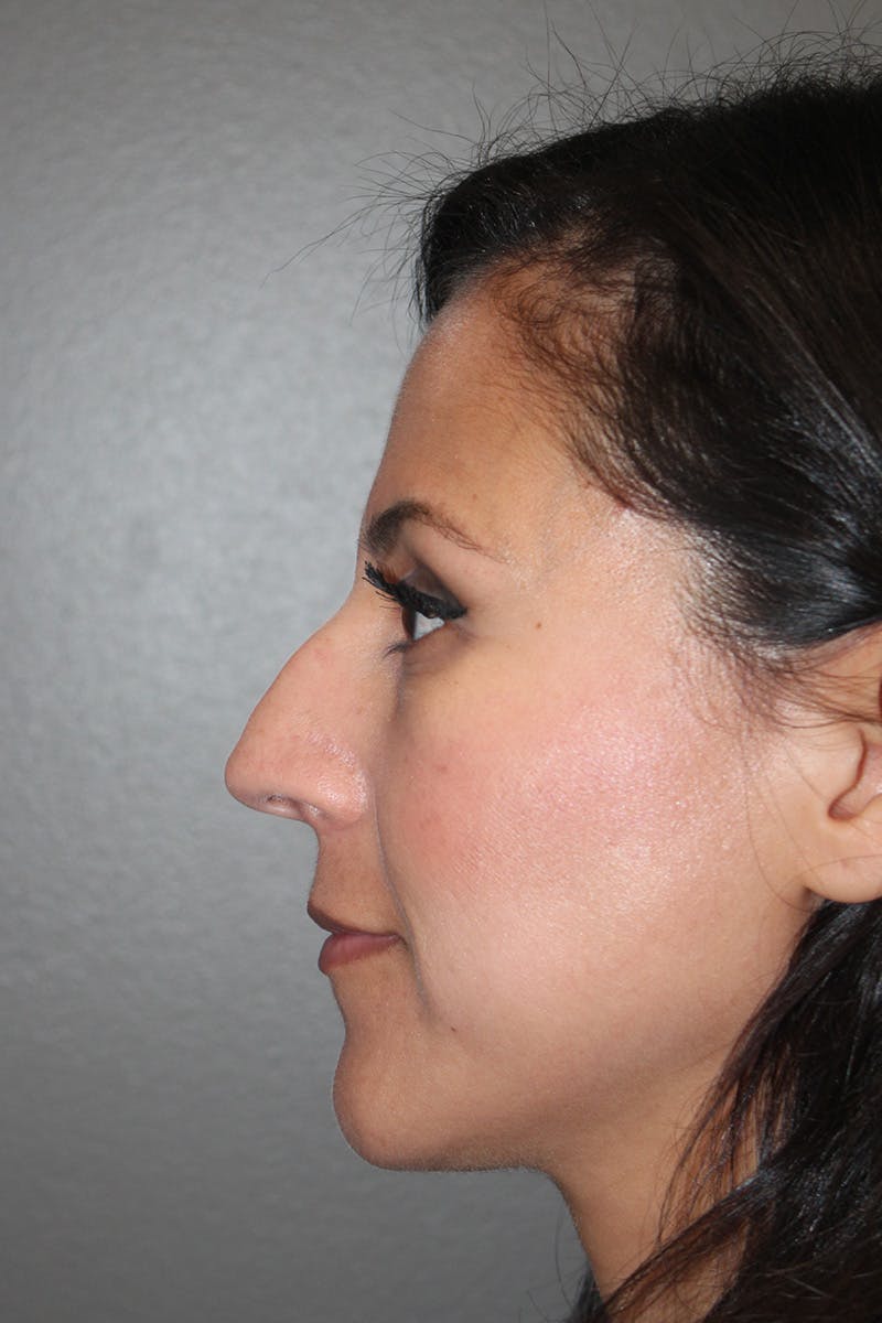 Rhinoplasty Before & After Gallery - Patient 174972181 - Image 9