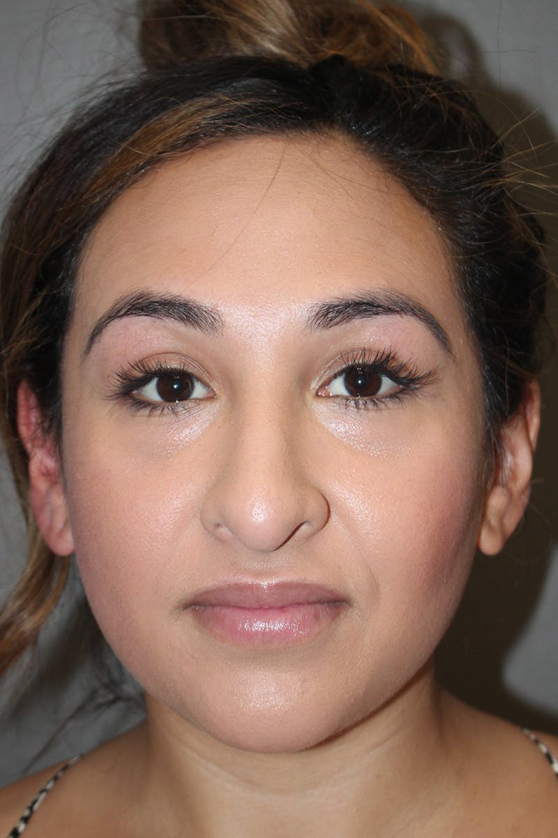 Rhinoplasty Before & After Gallery - Patient 174972202 - Image 5