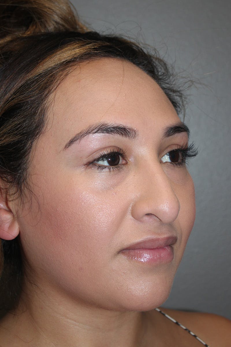 Rhinoplasty Before & After Gallery - Patient 174972202 - Image 3