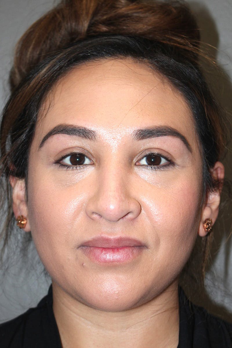 Rhinoplasty Before & After Gallery - Patient 174972202 - Image 6