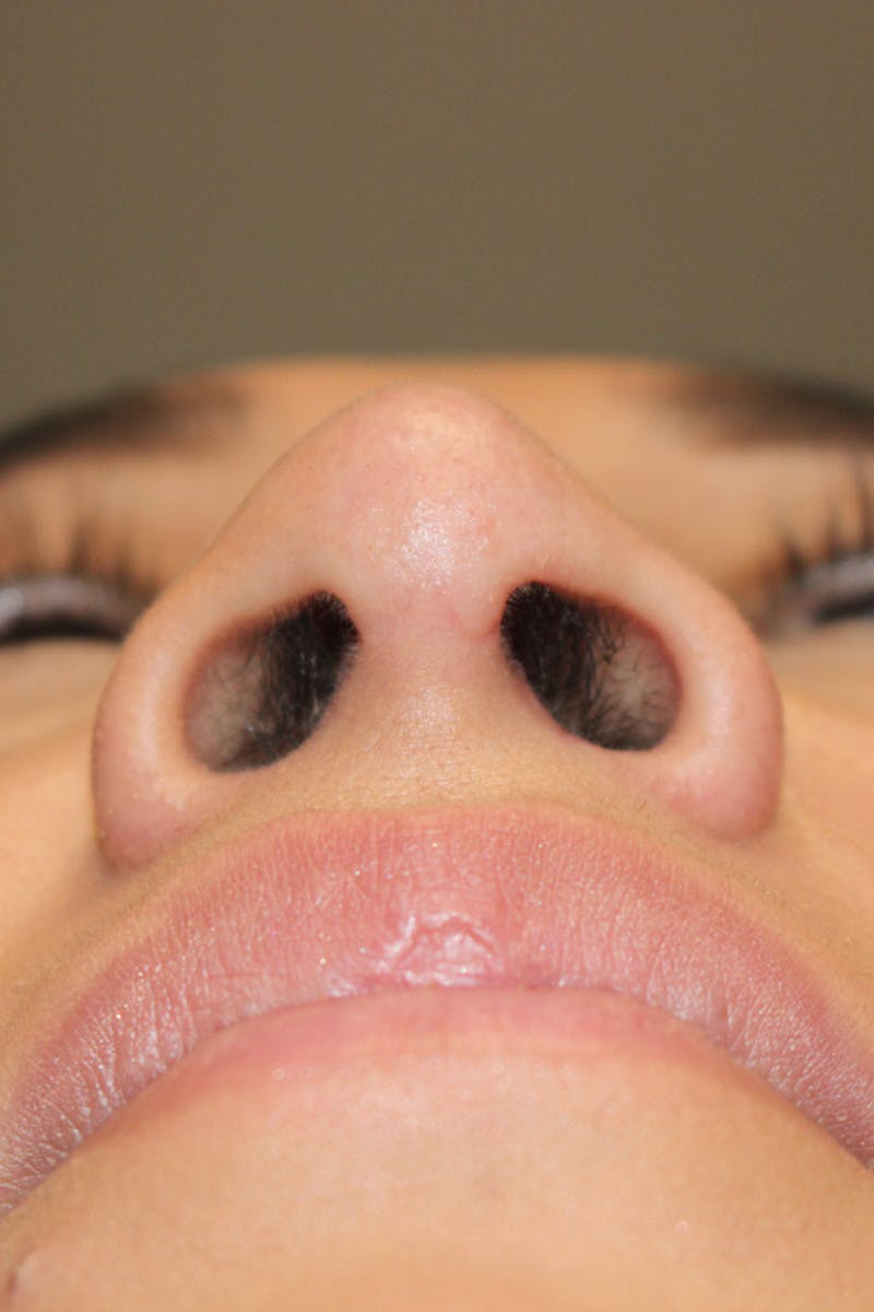 Rhinoplasty Before & After Gallery - Patient 174972202 - Image 12