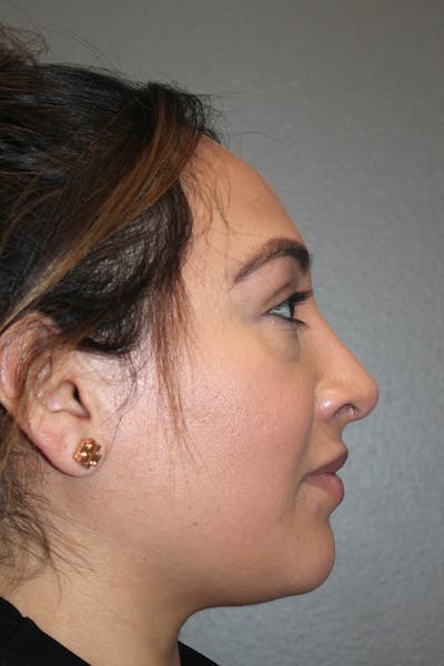 Rhinoplasty Before & After Gallery - Patient 174972202 - Image 2