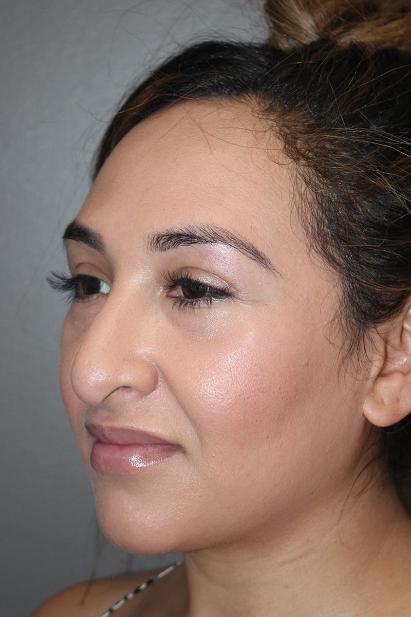 Rhinoplasty Before & After Gallery - Patient 174972202 - Image 7