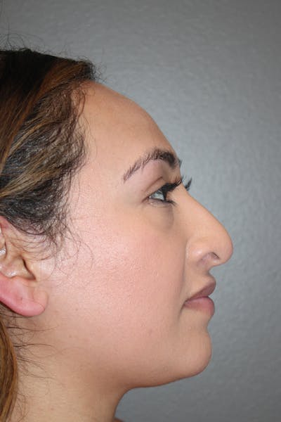 Rhinoplasty Before & After Gallery - Patient 174972202 - Image 1
