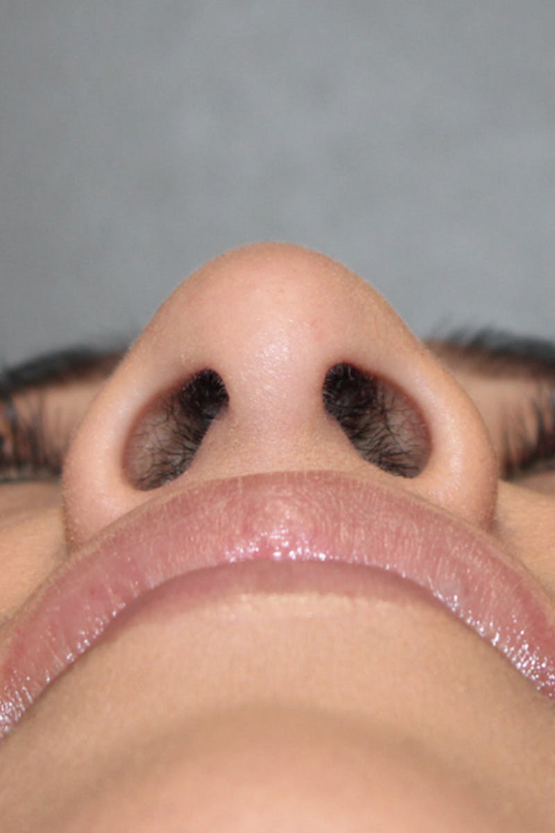 Rhinoplasty Before & After Gallery - Patient 174972202 - Image 11