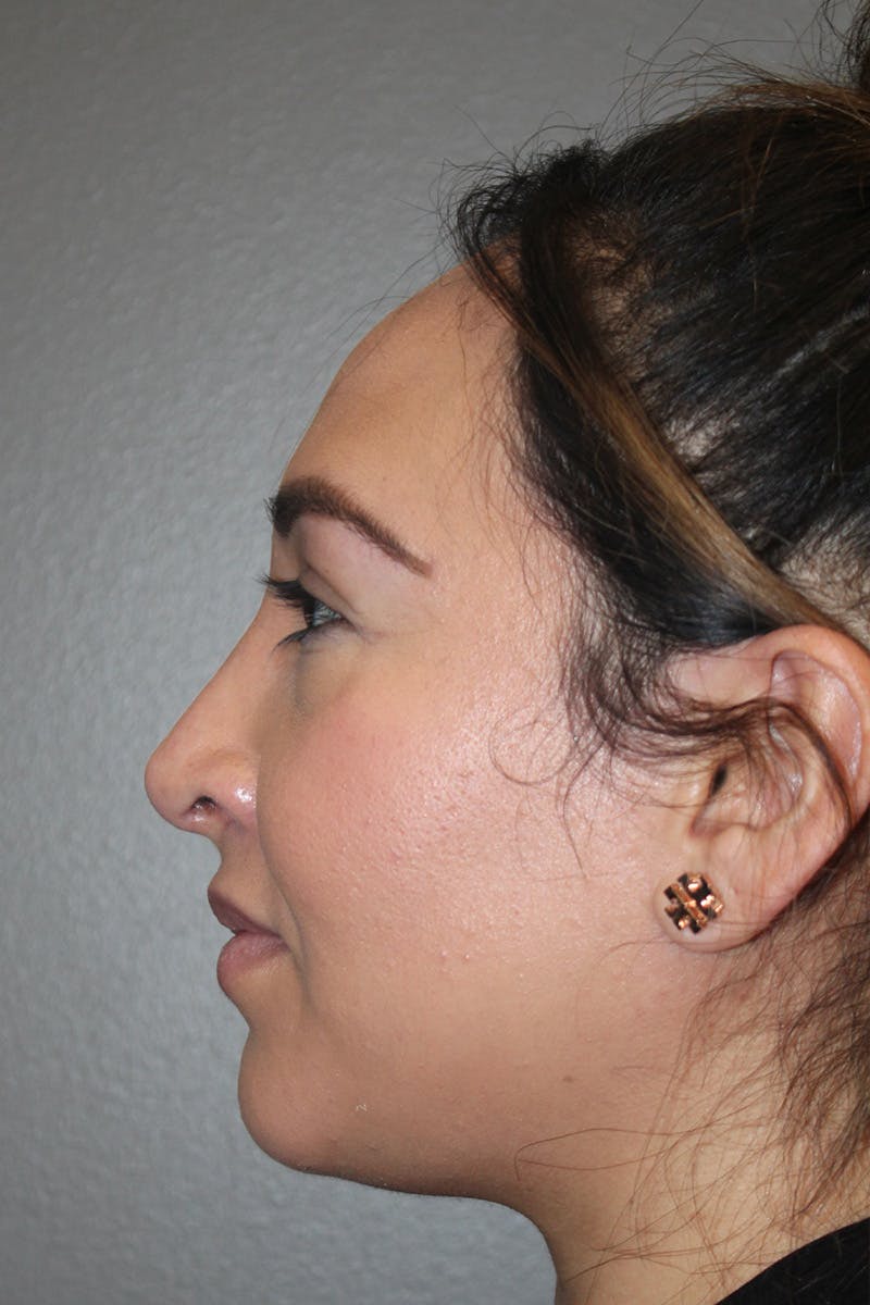 Rhinoplasty Before & After Gallery - Patient 174972202 - Image 10