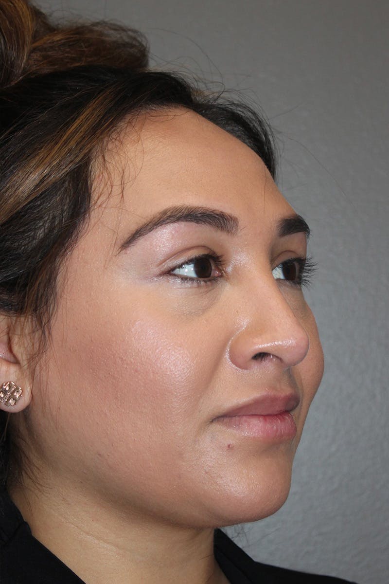 Rhinoplasty Before & After Gallery - Patient 174972202 - Image 4