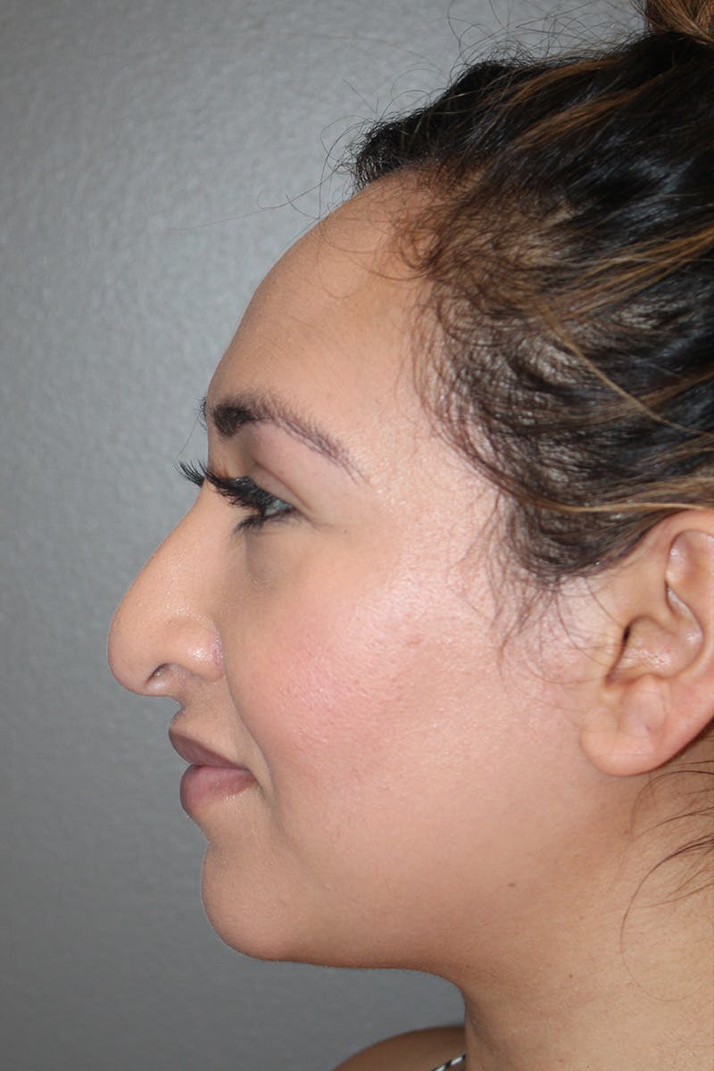 Rhinoplasty Before & After Gallery - Patient 174972202 - Image 9