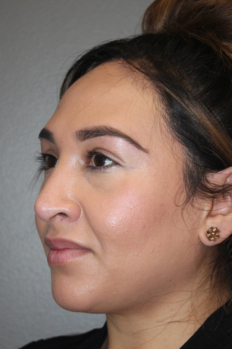 Rhinoplasty Before & After Gallery - Patient 174972202 - Image 8