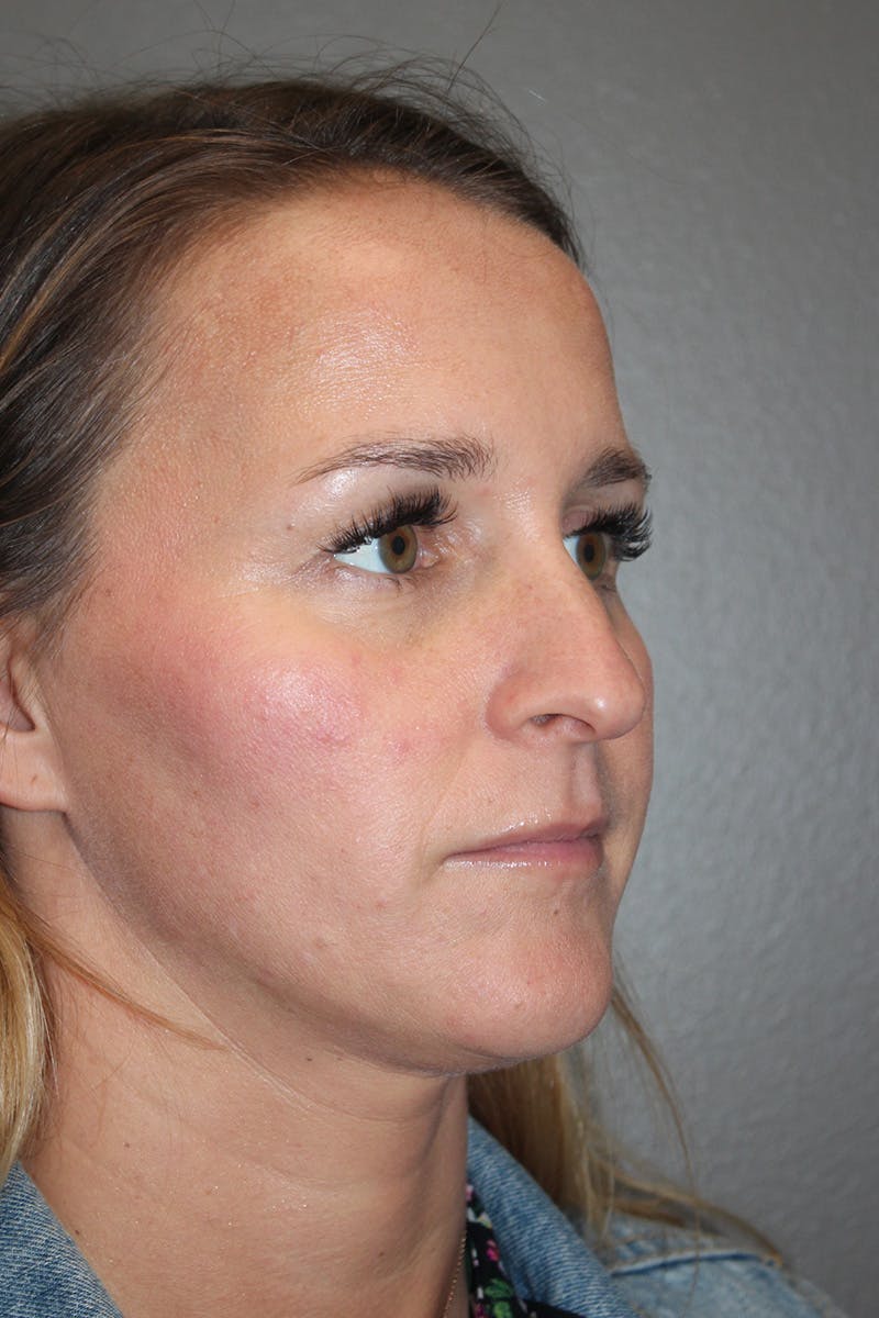 Rhinoplasty Before & After Gallery - Patient 174972203 - Image 3