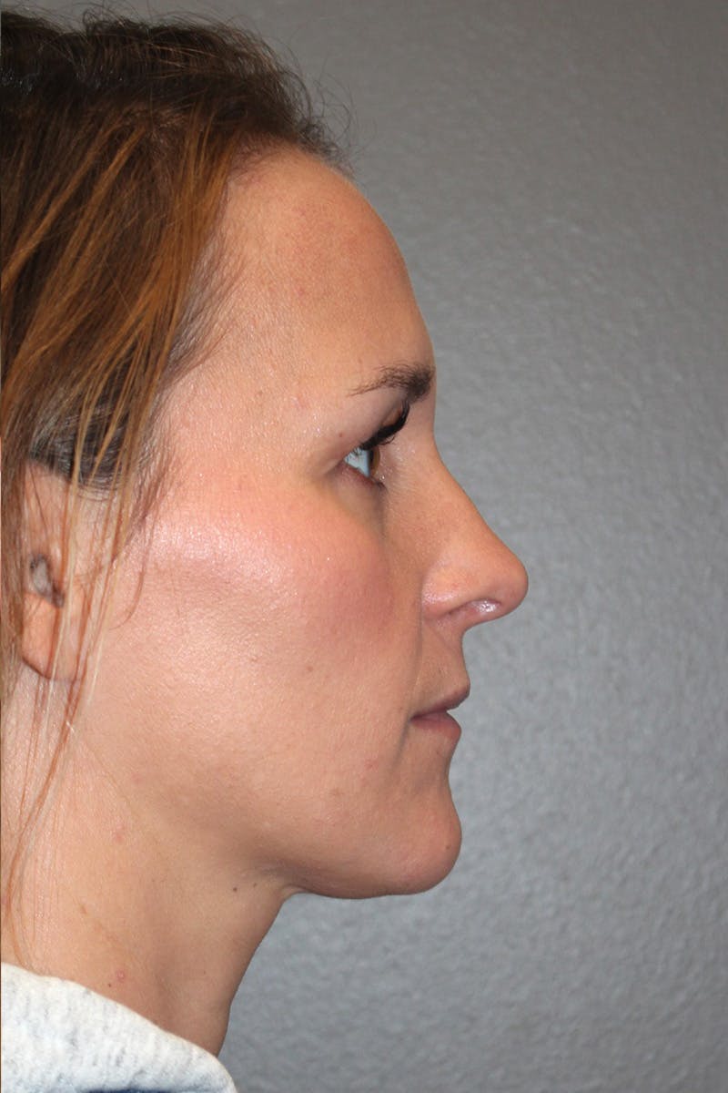 Rhinoplasty Before & After Gallery - Patient 174972203 - Image 2