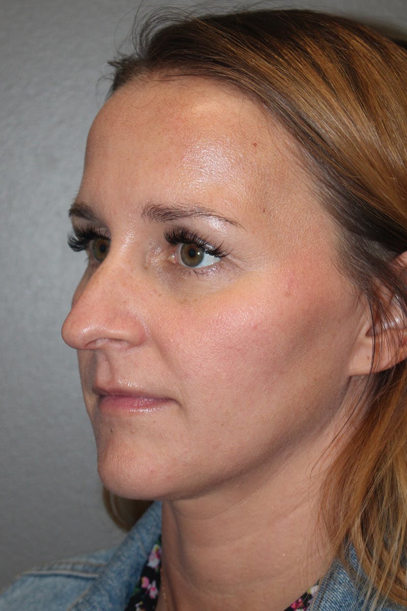 Rhinoplasty Before & After Gallery - Patient 174972203 - Image 7