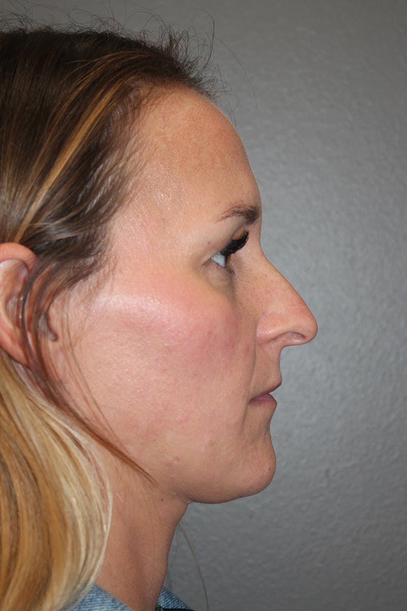 Rhinoplasty Before & After Gallery - Patient 174972203 - Image 1