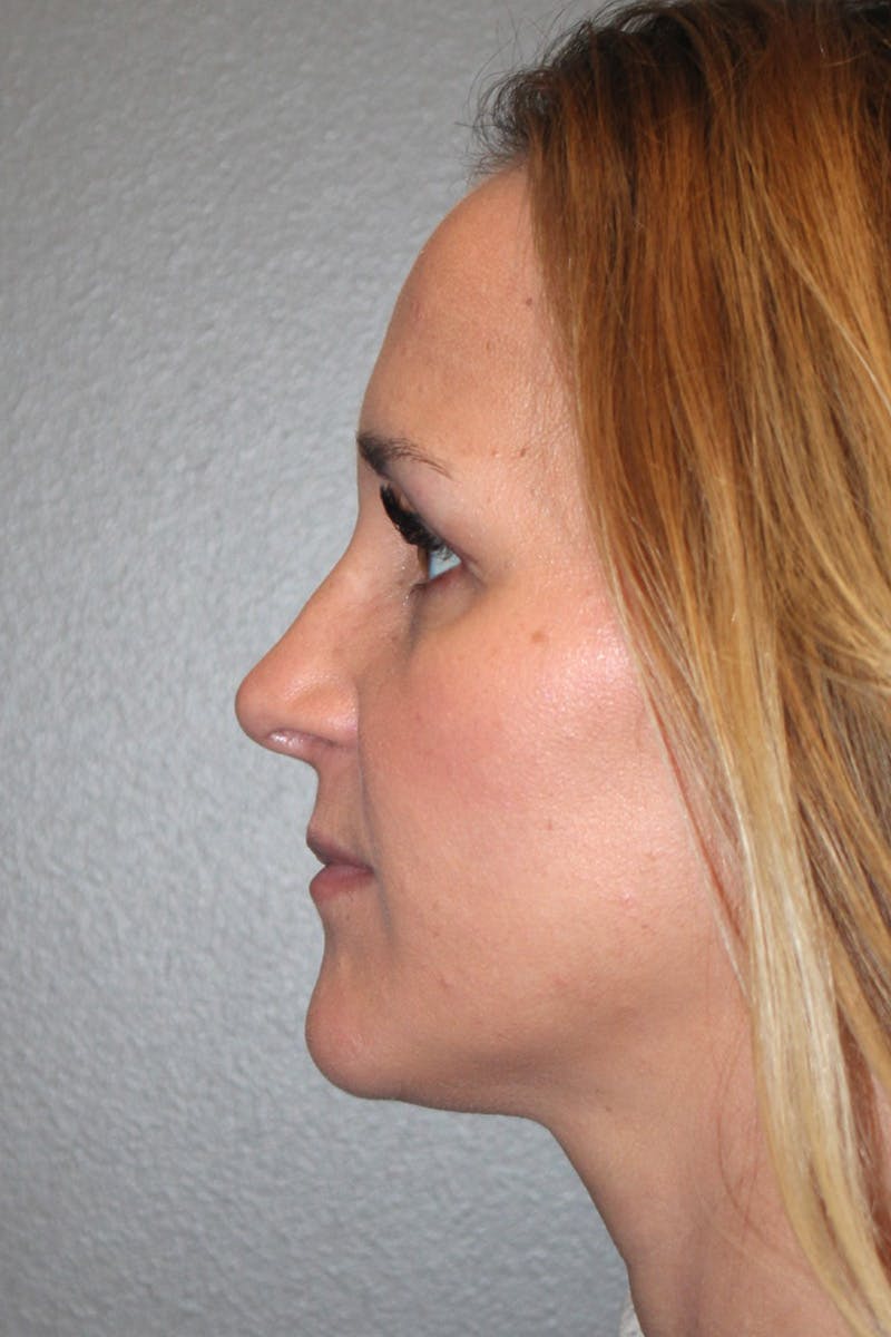 Rhinoplasty Before & After Gallery - Patient 174972203 - Image 11