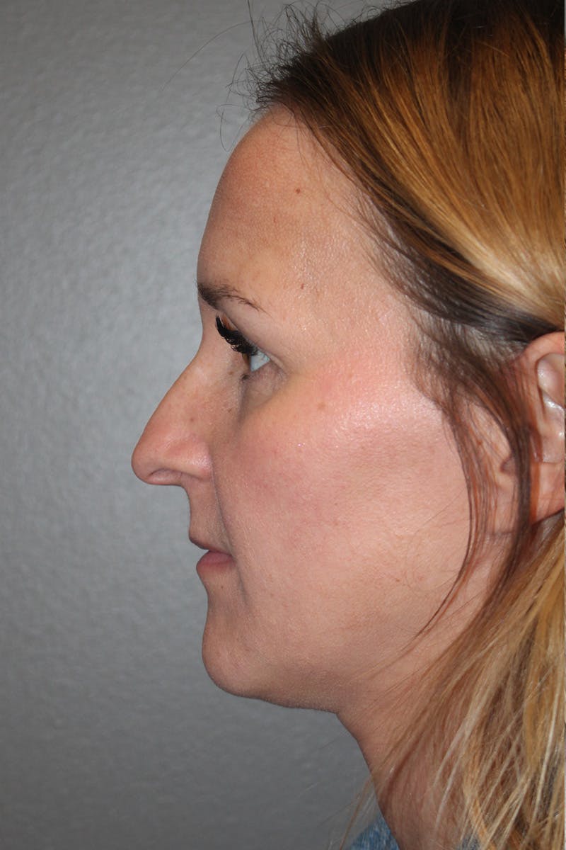 Rhinoplasty Before & After Gallery - Patient 174972203 - Image 10
