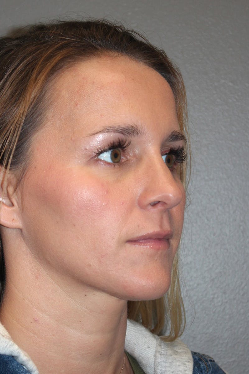 Rhinoplasty Before & After Gallery - Patient 174972203 - Image 4