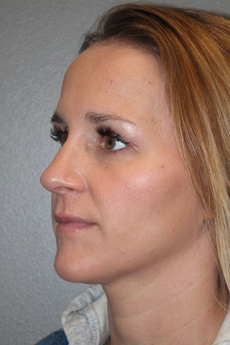 Rhinoplasty Before & After Gallery - Patient 174972203 - Image 8