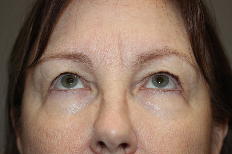 Eyelid surgery Before & After Gallery - Patient 174973058 - Image 3