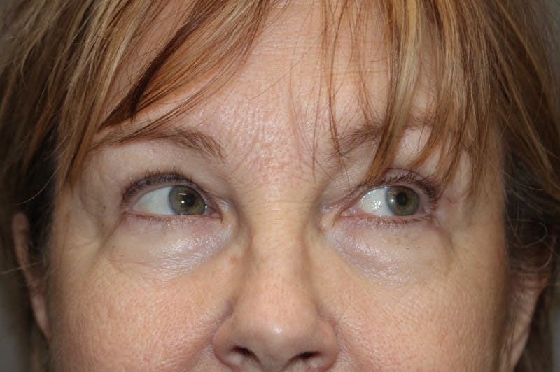 Eyelid surgery Before & After Gallery - Patient 174973058 - Image 4