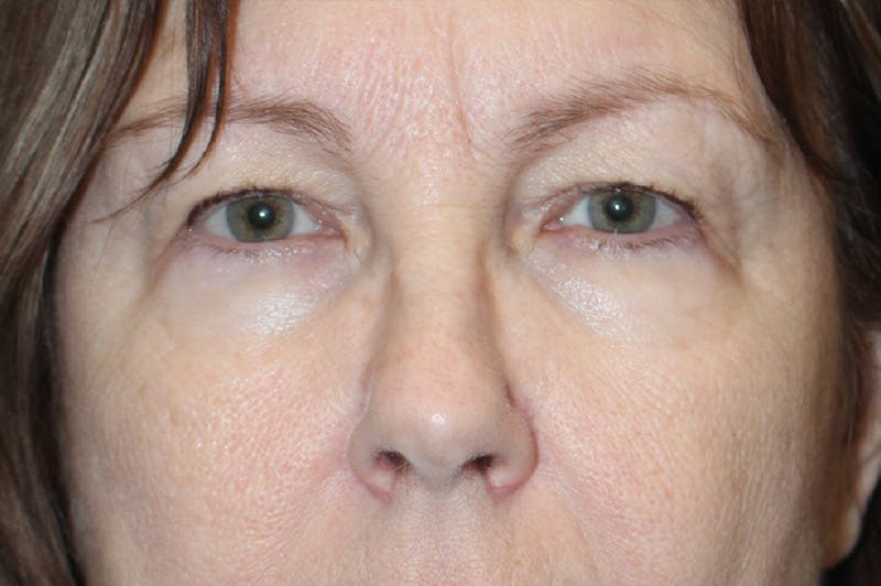 Eyelid surgery Before & After Gallery - Patient 174973058 - Image 5