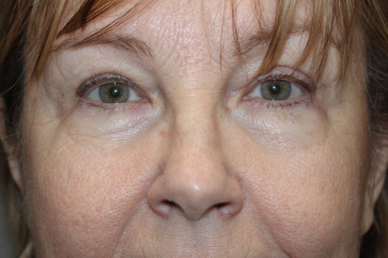 Eyelid surgery Before & After Gallery - Patient 174973058 - Image 6