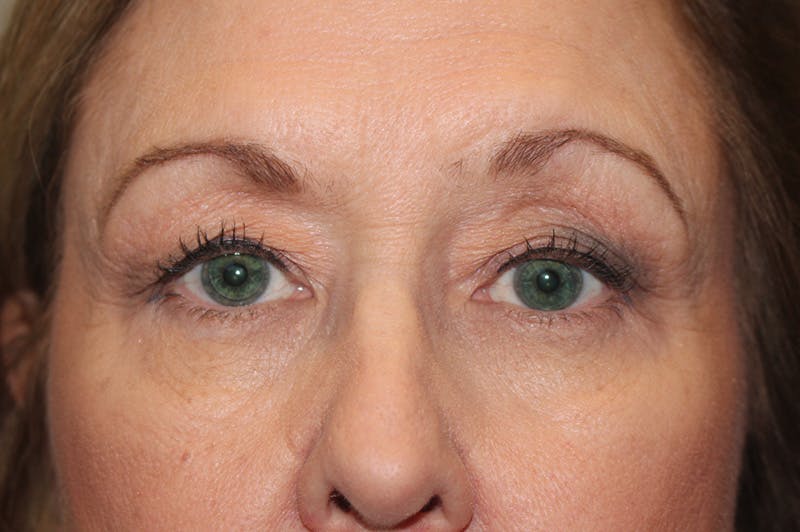 Eyelid surgery Before & After Gallery - Patient 174973057 - Image 1