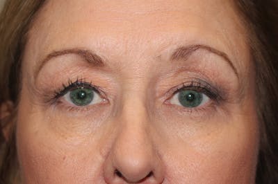 Eyelid surgery Before & After Gallery - Patient 174973057 - Image 1
