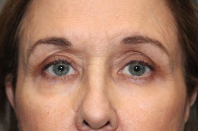 Eyelid surgery Before & After Gallery - Patient 174973057 - Image 2