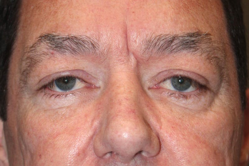 Eyelid surgery Before & After Gallery - Patient 174973056 - Image 1