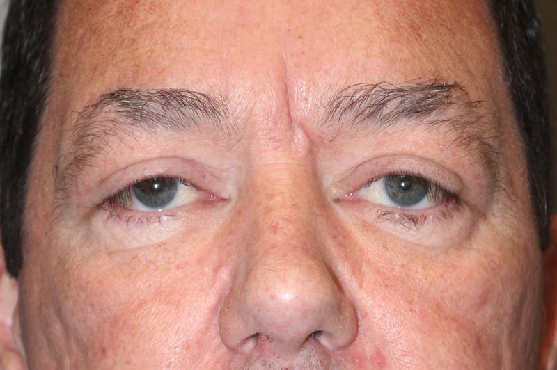 Eyelid surgery Before & After Gallery - Patient 174973056 - Image 2