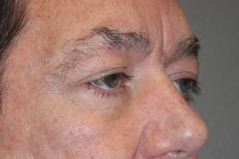 Eyelid surgery Before & After Gallery - Patient 174973056 - Image 3