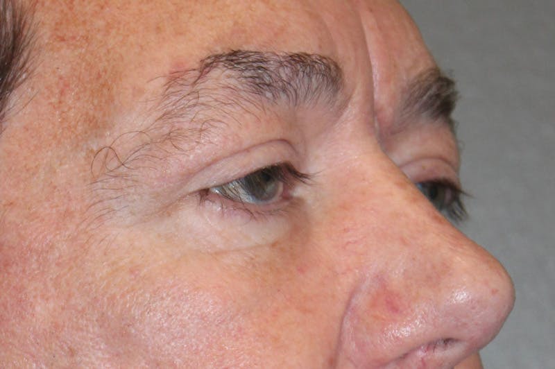 Eyelid surgery Before & After Gallery - Patient 174973056 - Image 4