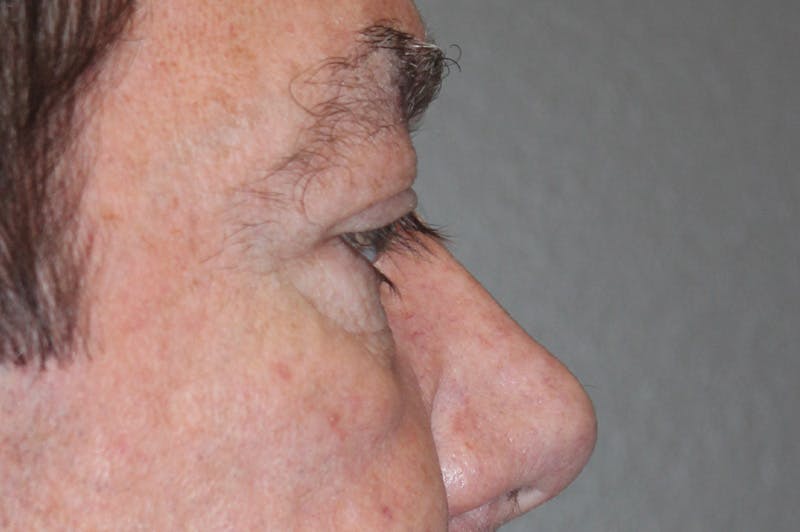 Eyelid surgery Before & After Gallery - Patient 174973056 - Image 5