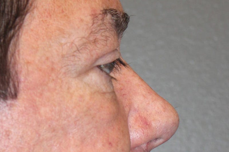 Eyelid surgery Before & After Gallery - Patient 174973056 - Image 6
