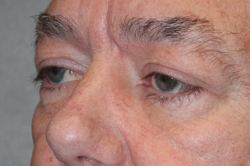 Eyelid surgery Before & After Gallery - Patient 174973056 - Image 7