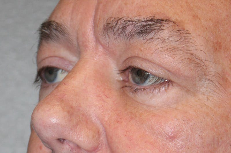 Eyelid surgery Before & After Gallery - Patient 174973056 - Image 8