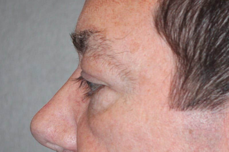 Eyelid surgery Before & After Gallery - Patient 174973056 - Image 9