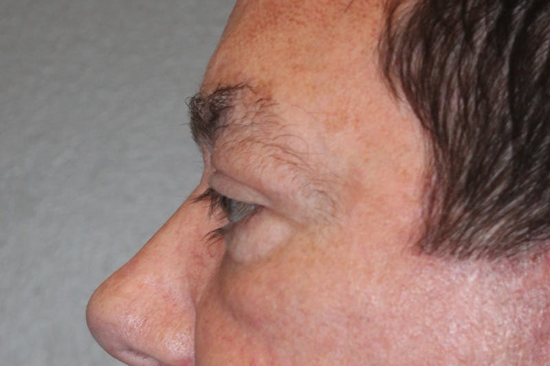 Eyelid surgery Before & After Gallery - Patient 174973056 - Image 10