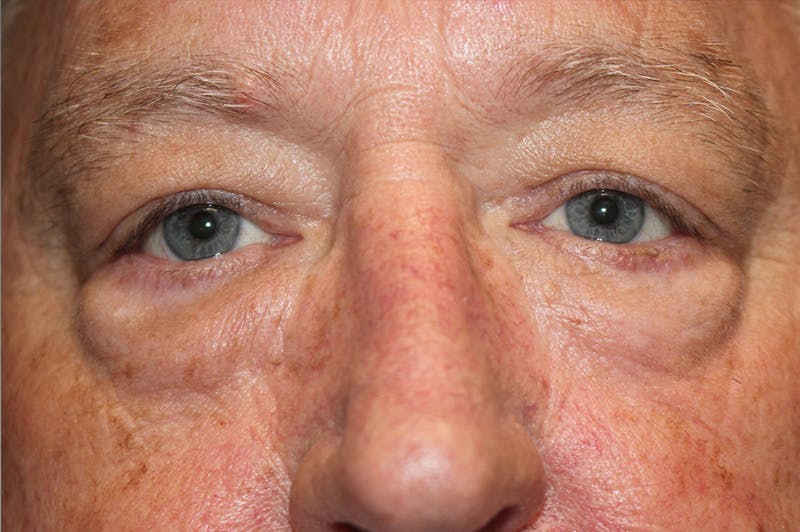 Eyelid surgery Before & After Gallery - Patient 174973499 - Image 1