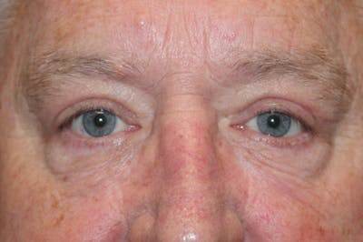 Eyelid surgery Before & After Gallery - Patient 174973499 - Image 2