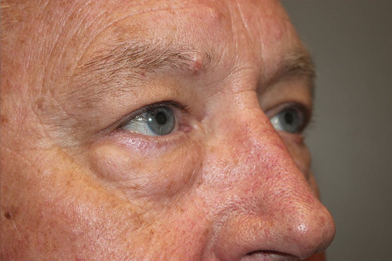 Eyelid surgery Before & After Gallery - Patient 174973499 - Image 3