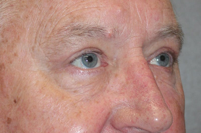 Eyelid surgery Before & After Gallery - Patient 174973499 - Image 4