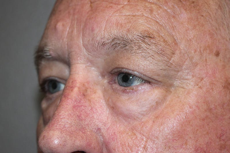 Eyelid surgery Before & After Gallery - Patient 174973499 - Image 5
