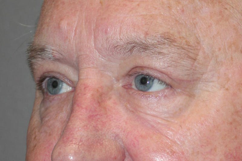 Eyelid surgery Before & After Gallery - Patient 174973499 - Image 6