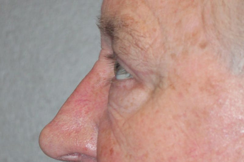 Eyelid surgery Before & After Gallery - Patient 174973499 - Image 8