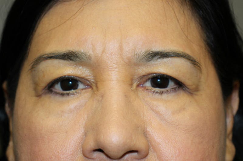 Eyelid surgery Before & After Gallery - Patient 174973516 - Image 1