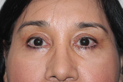 Eyelid surgery Before & After Gallery - Patient 174973516 - Image 2