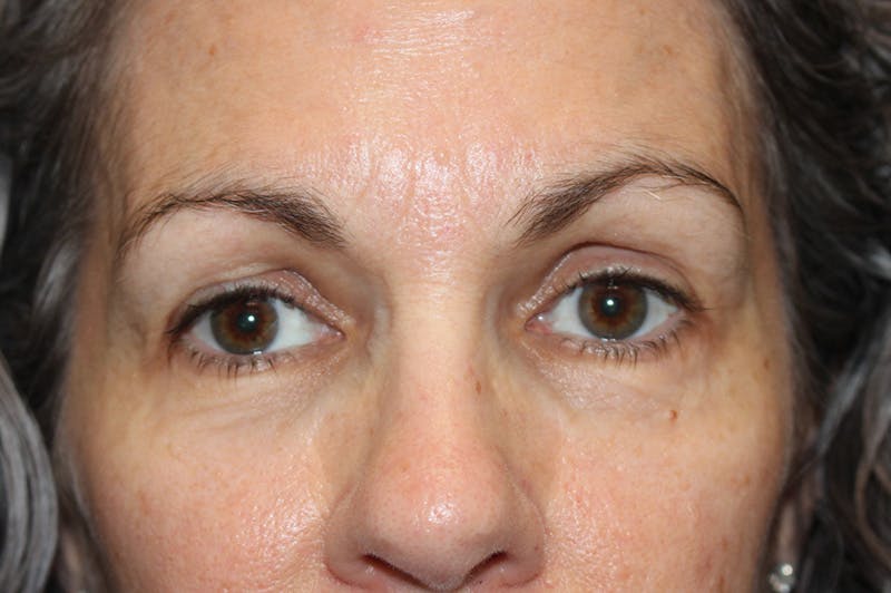 Eyelid surgery Before & After Gallery - Patient 174973515 - Image 1