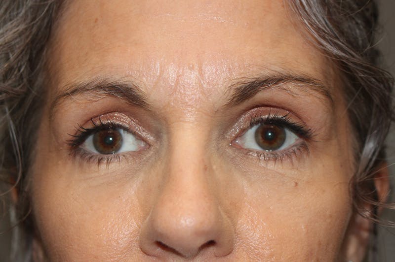 Eyelid surgery Before & After Gallery - Patient 174973515 - Image 2
